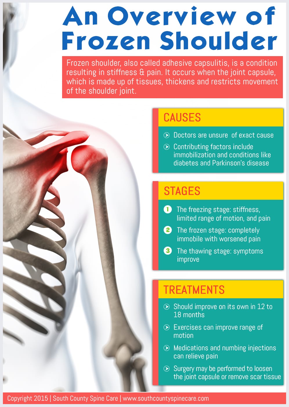 An Overview of Frozen Shoulder South County Spine Care Center