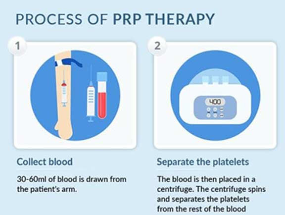 Process-of-PRP-Therapy-South-County-Spine-Care